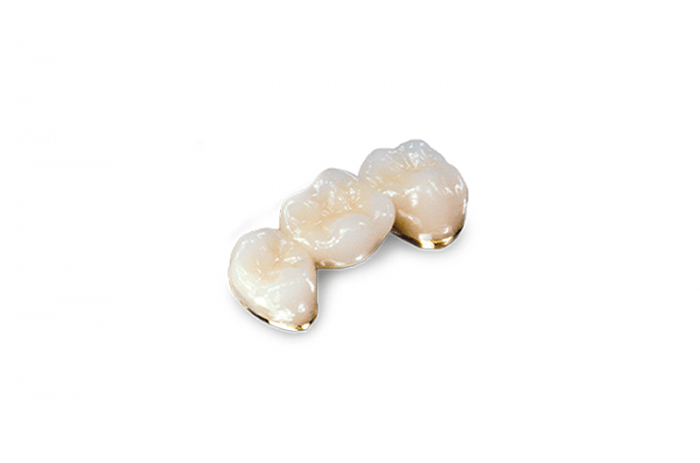 Coronas dentales de porcelana y oro