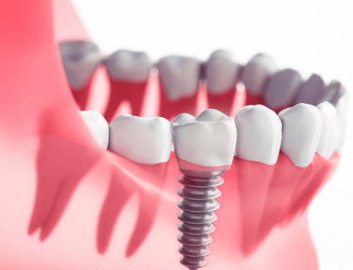 Cosas que no sabías de los implantes dentales