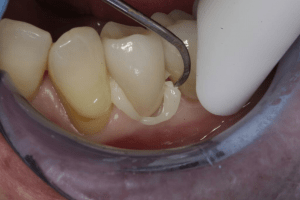 Cementando una corona dental