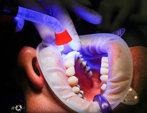 ¿Cementar una prótesis dental?