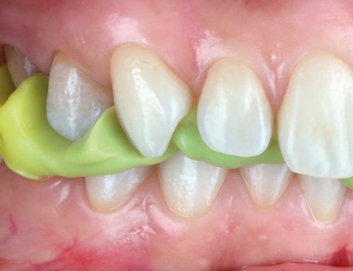 "El Poder del Registro Oclusal" | La Clave para Prótesis Dentales Exitosas
